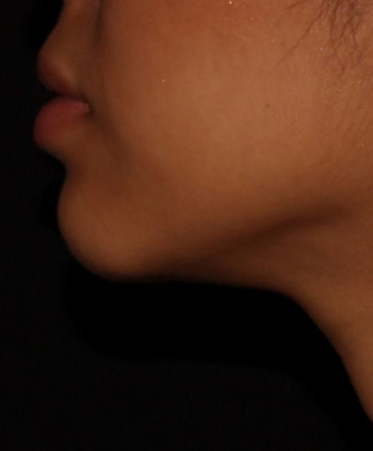 After Chin Augmentation
