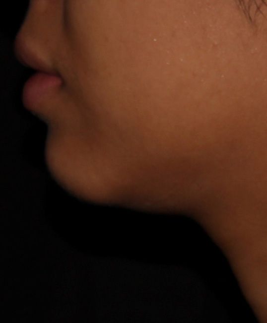 Before Chin Augmentation