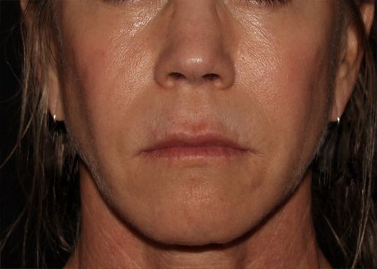 After CO2 Laser