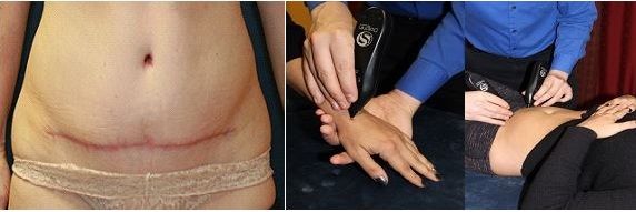 dark scar on lower abdomen