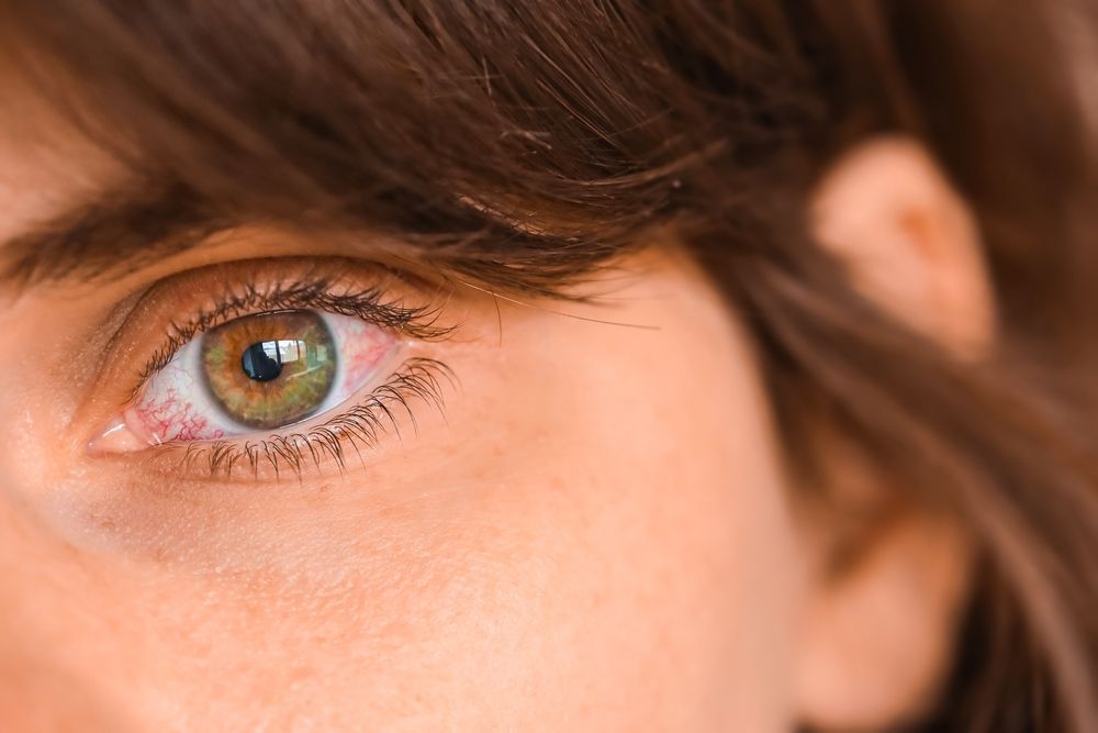 The Causes and Symptoms of Dry Eye