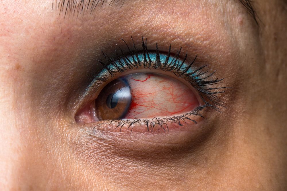 Learn More About Uveitis: Causes and Symptoms