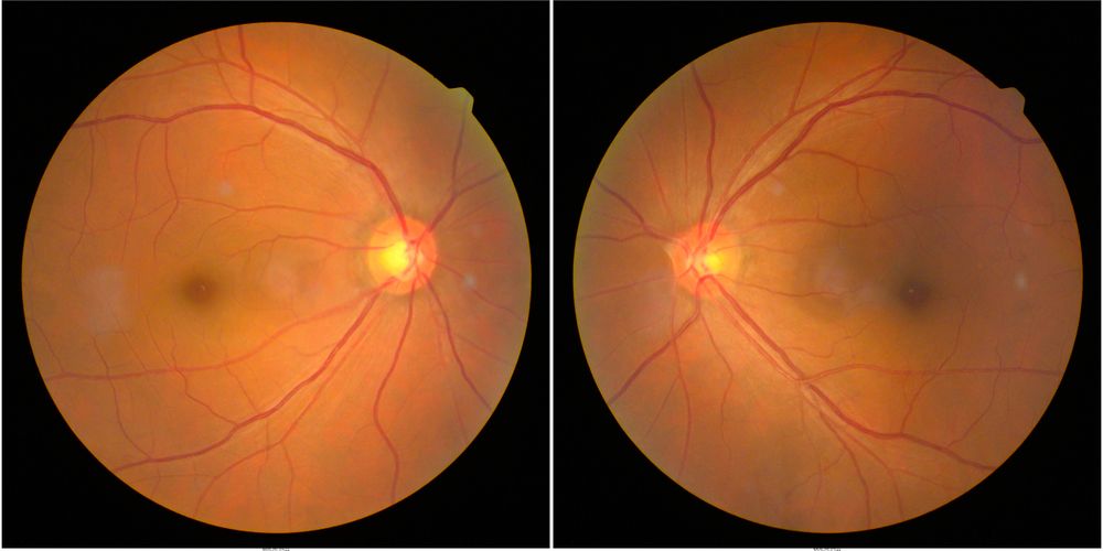 Detecting Hypertensive Retinopathy: Signs, Symptoms, and Diagnosis