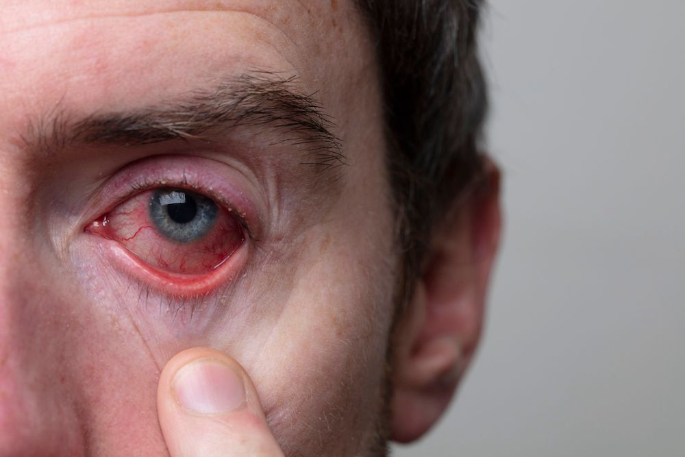 Distinguishing Between Dry Eye and Ocular Allergies