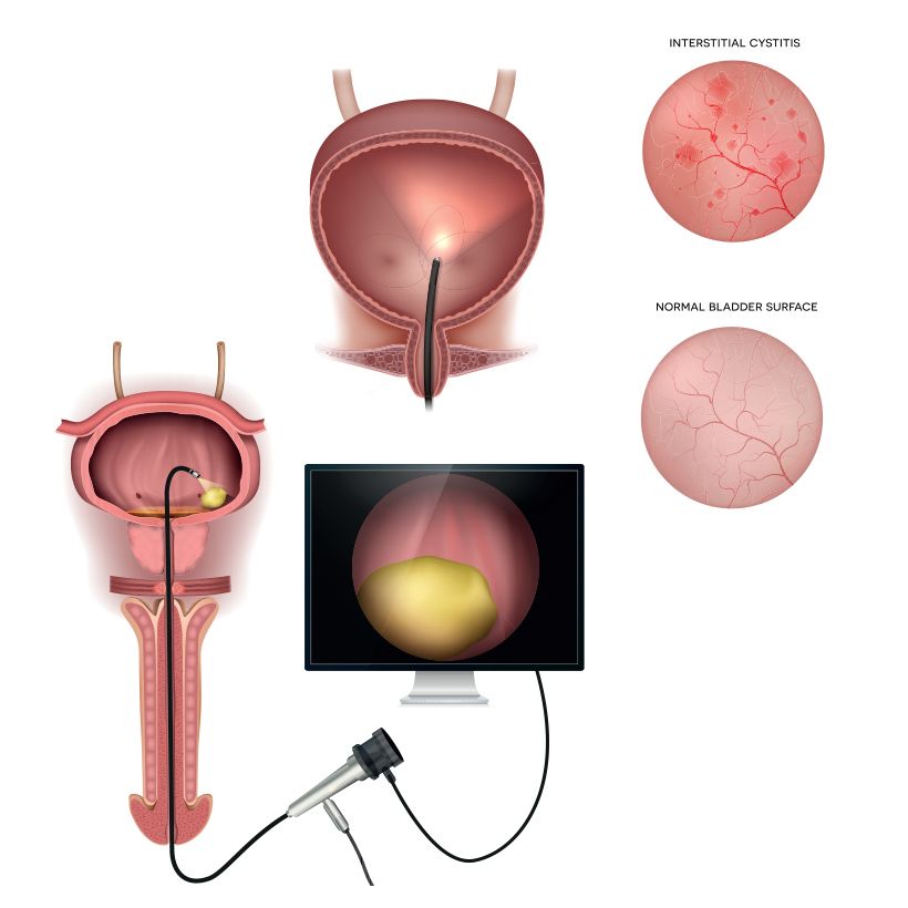 Interstitial Cystitis