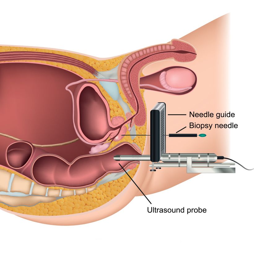 Prostate Biopsy