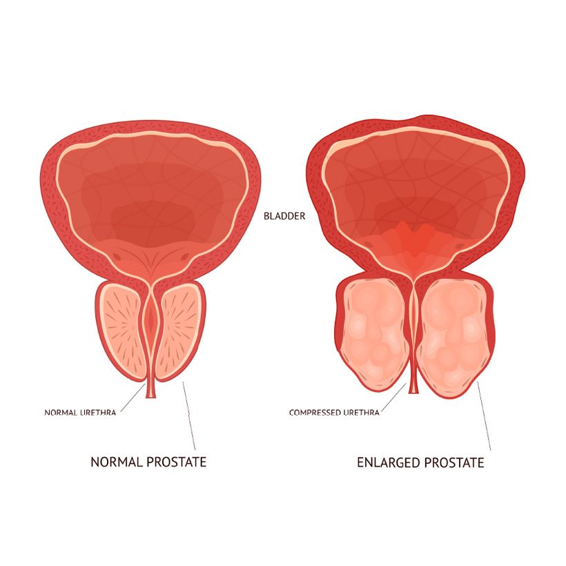 Prostatitis and BPH