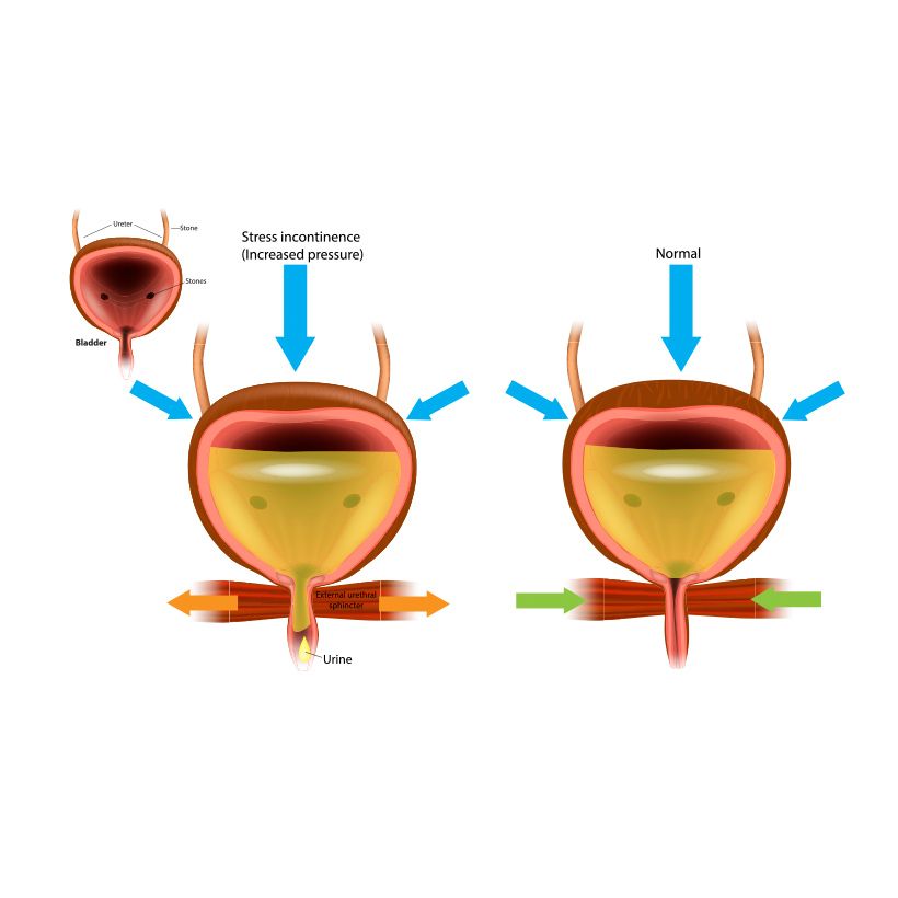 Stress Incontinence