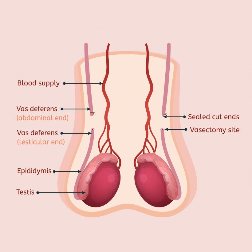 Vasectomy