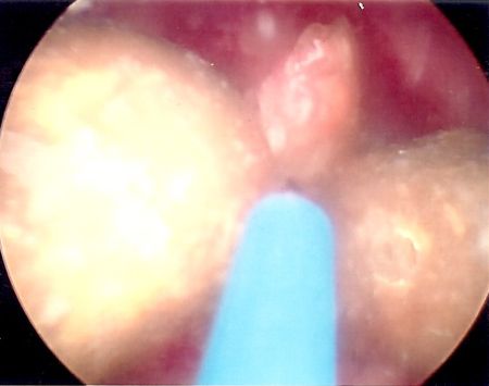 laser lithotripsy