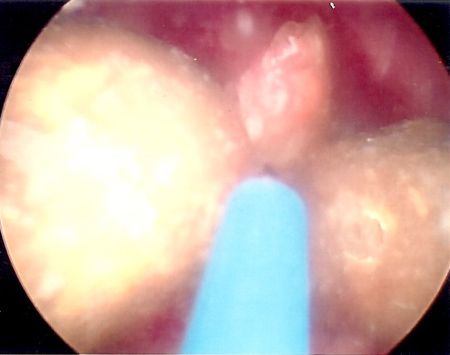 laser lithotripsy