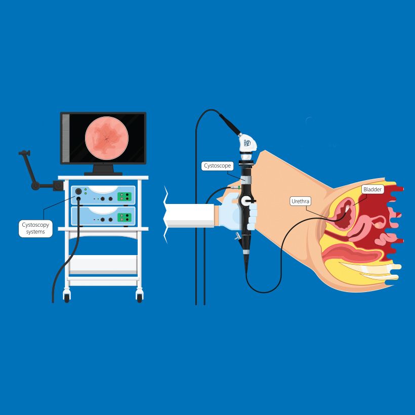 cytoscopy