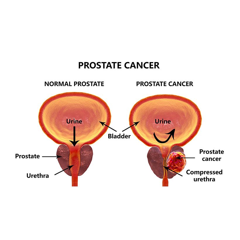 prostate cancer