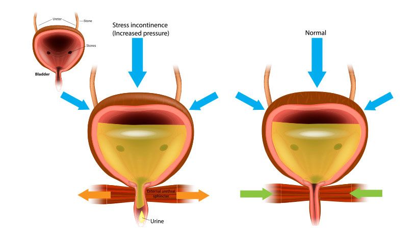 incontinence