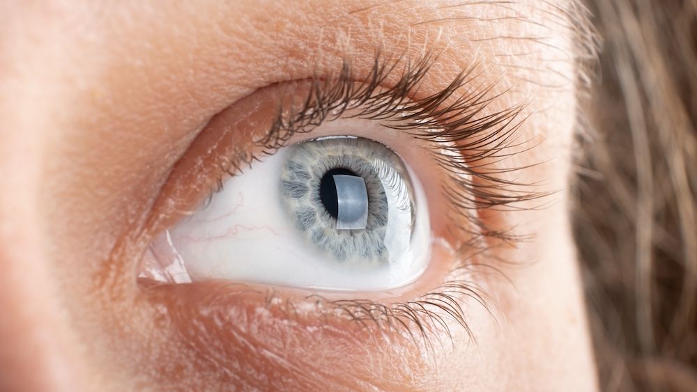 I Have Keratoconus: How Can Corneal Cross-linking Help Me?