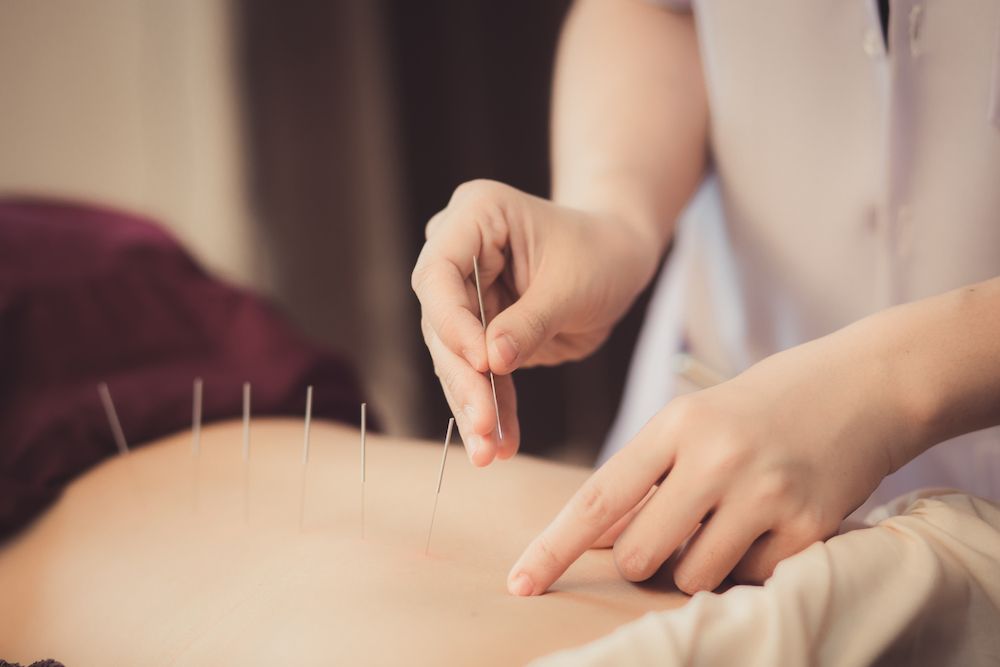 What Is Acupuncture?