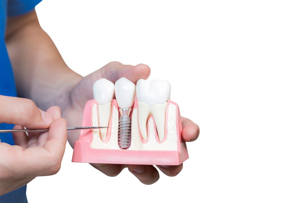 Do’s and Don'ts After Dental Implants