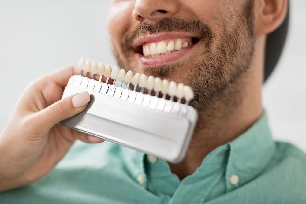 What are the Top Benefits of Dental Veneers?