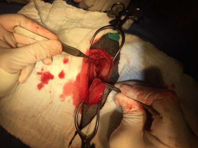 Intraoperative torn muscle #2