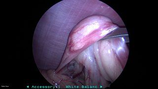 Laparoscopy #1