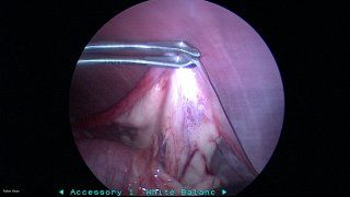 Laparoscopy #2