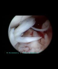 Arthoscopy image