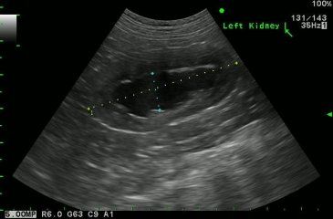 Hydronephrotic kidney ultrasound