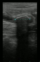 Hydroureter kidney ultrasound