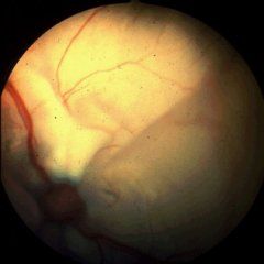 Retinal detachment