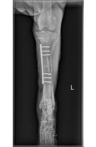 Post Op Ap Radiograph