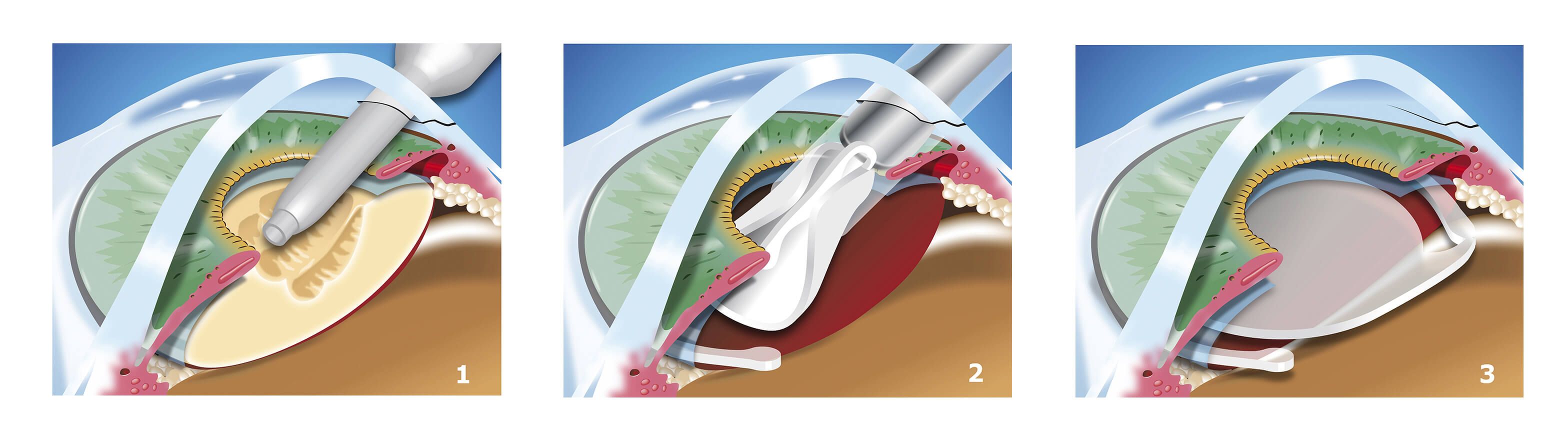 dropless cataract surgery