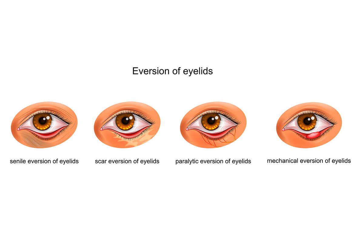 Chalazion Removal