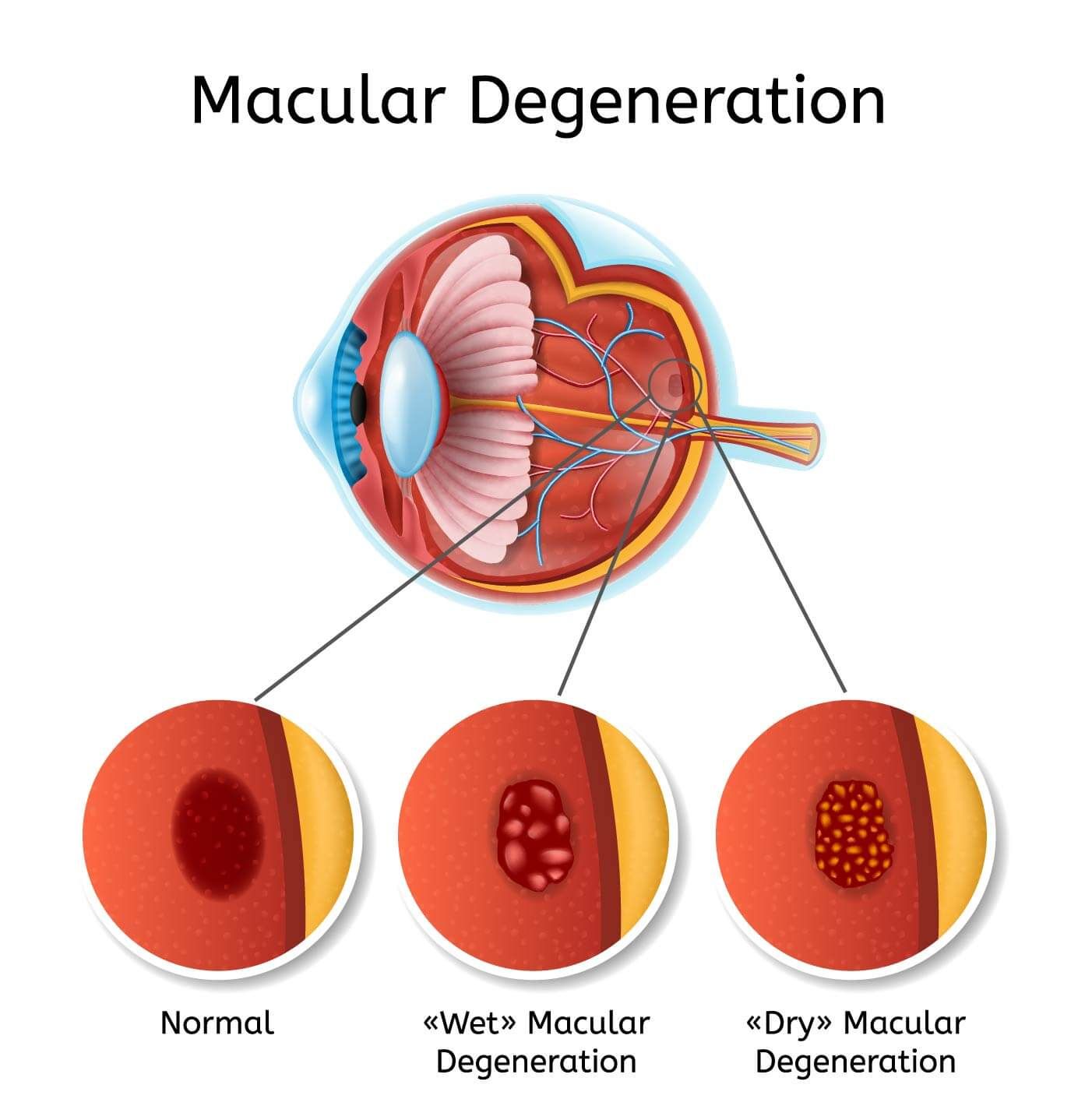 types of macular degeneration
