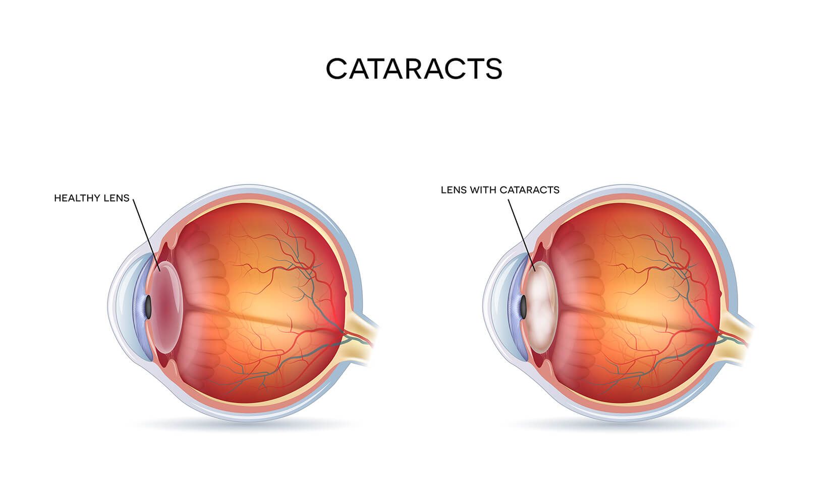 cataract diagram