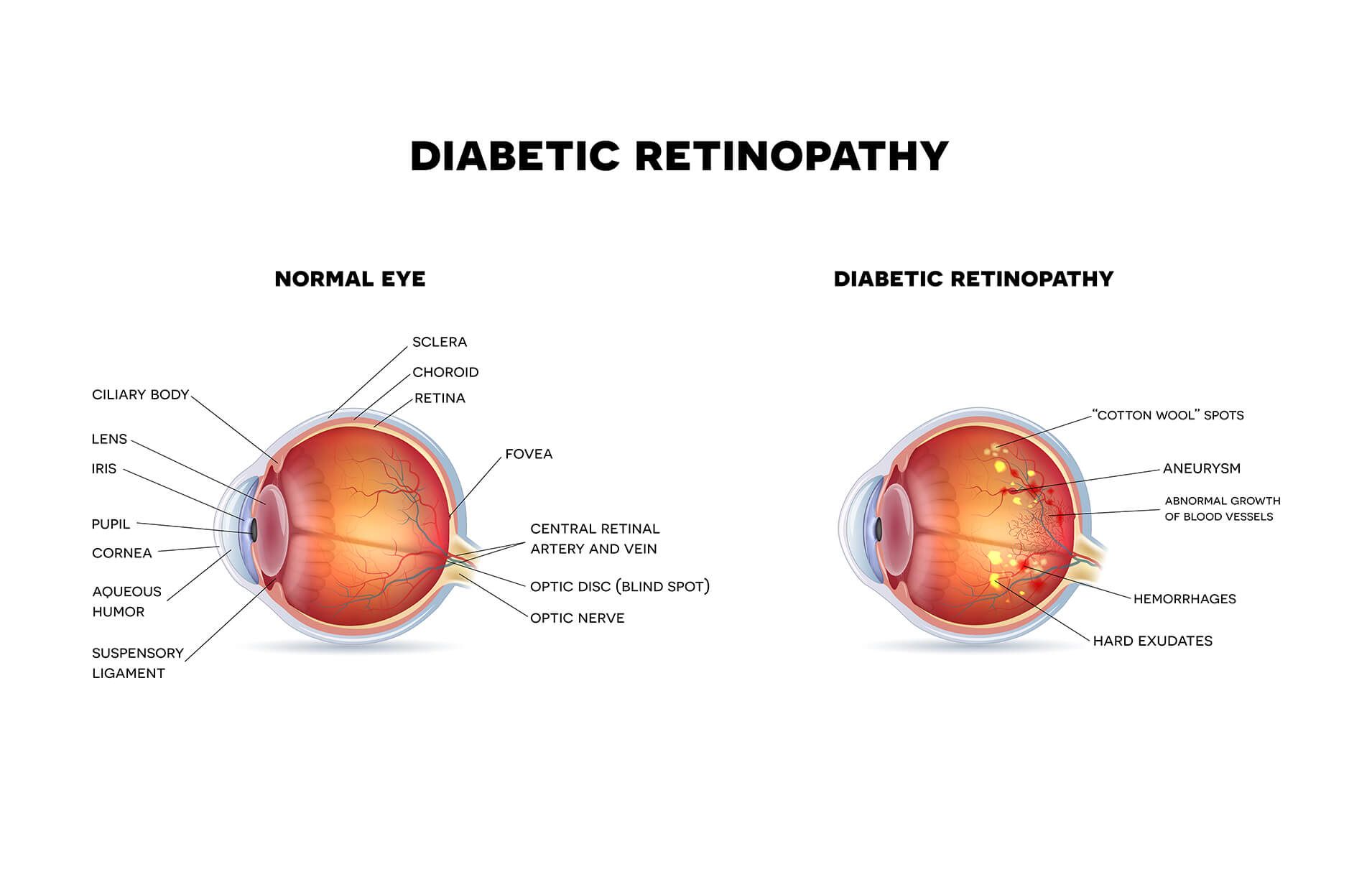diabetic retinopathy