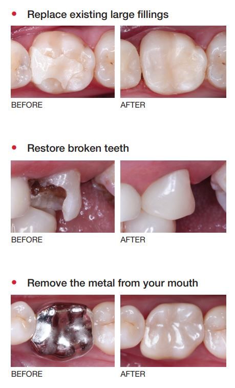 dental veneer before and after