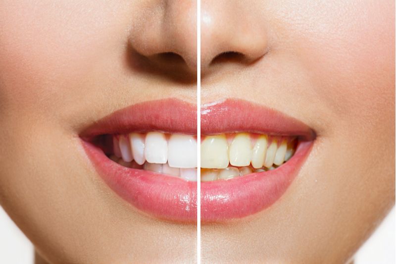 teeth whitening larchmont ny