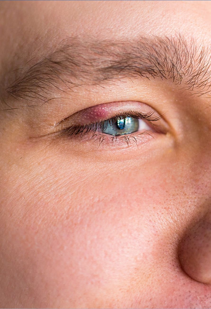 Stye