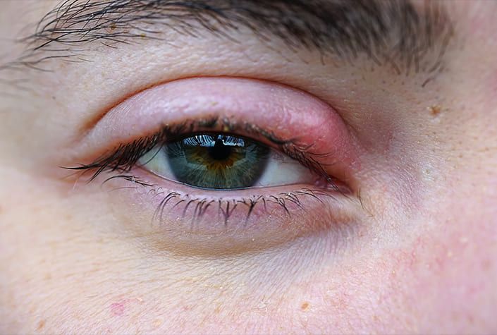 stye