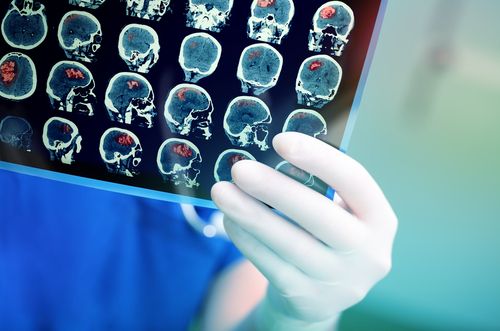 traumatic brain injury