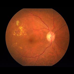 Diabetic Retinopathy