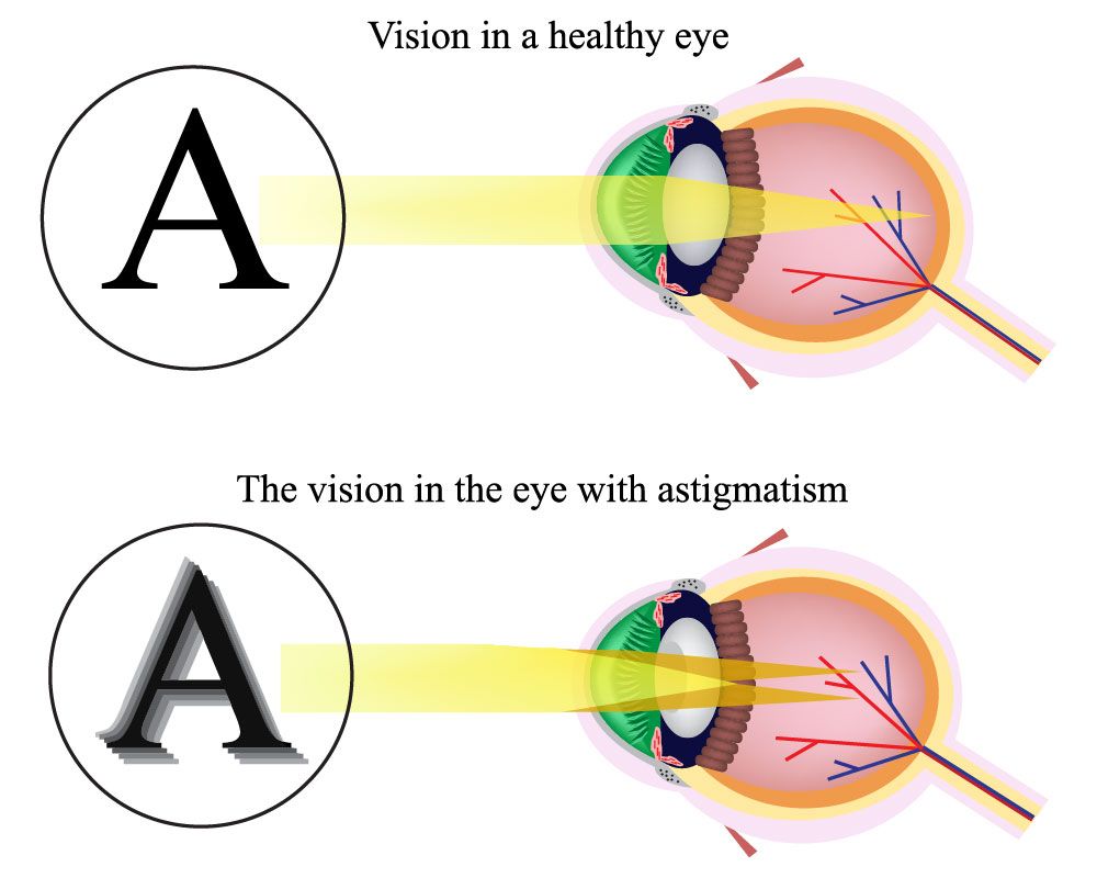 Do You Have An Astigmatism? - Bella Eye Care Optometry