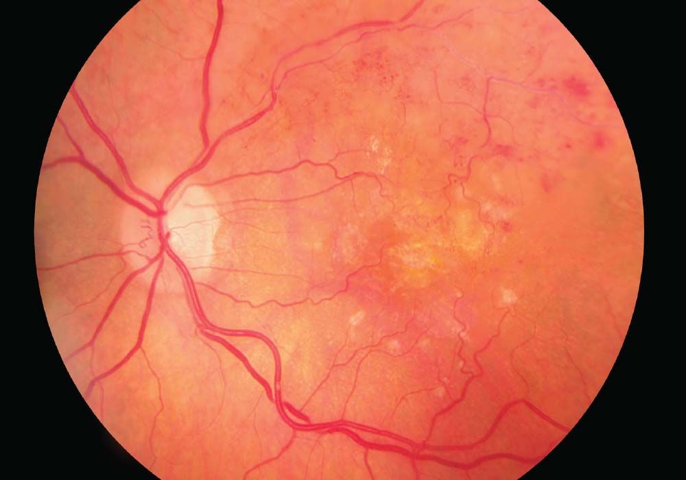 February Is Age-Related Macular Degeneration (AMD) Month - Bella Eye Care Optometry