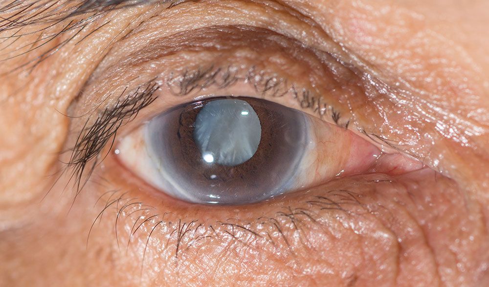 June is Cataract Awareness Month - Bella Eye Care Optometry