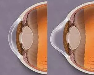 Keratoconus