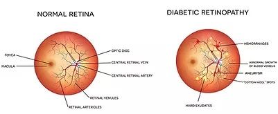Diabetic eye examination