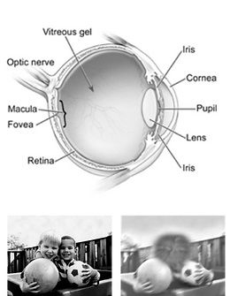 Macular Degeneration