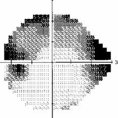 What is Glaucoma? How is Glaucoma diagnosed and treated?