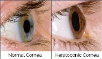 Scleral Contact Lenses do not contact the Cornea at all!