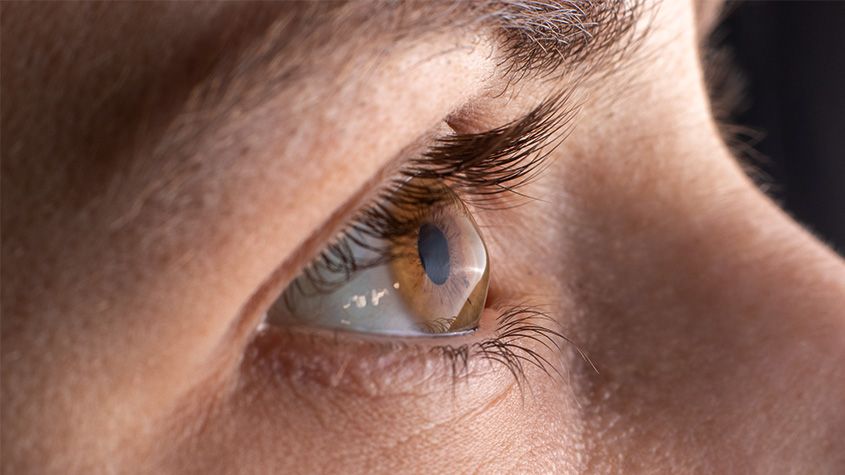 Keratoconus